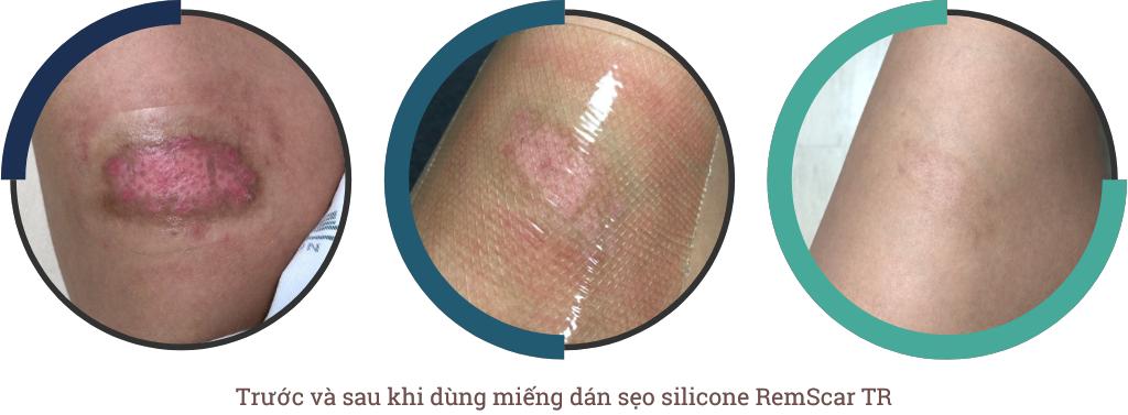 Sẹo bỏng sử dụng miếng dán sẹo RemScar TR