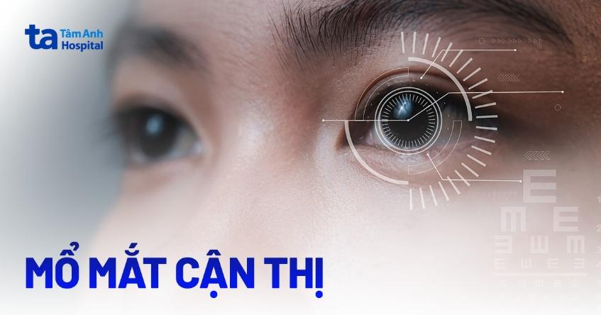 Mổ mắt cận thị: Công dụng, chỉ định, quy trình, chăm sóc phục hồi